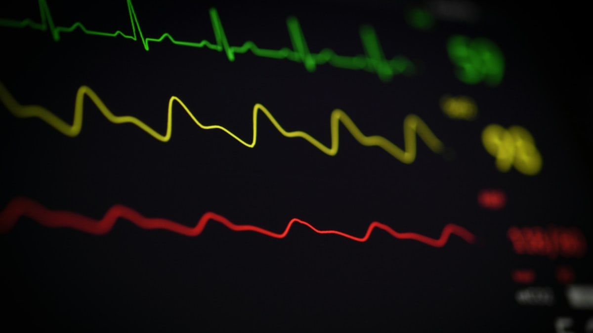 a close up of a computer screen with a line of ecg